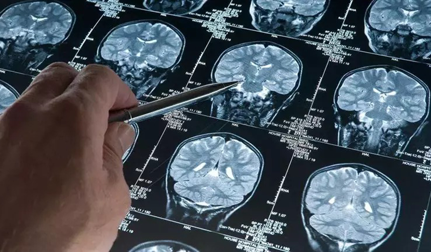 Uyku ilacı, Alzheimer ile ilişkili proteinlerin birikimini azaltabilir...
